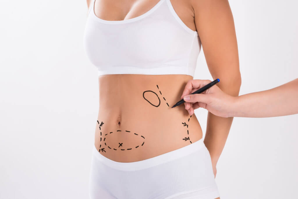 Tumescent Liposuction: Price, Procedure, and Results